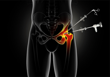 Hip Surgery - Educational Picture