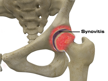 Hip Synovitis - Educational Picture