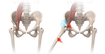 Iliopsoas Impingement - Educational Picture