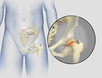 Irritable Hip - Educational Picture