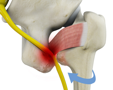 Ischiofemoral Impingement - Educational Picture