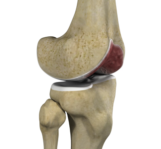 Knee Arthritis - Educational Picture