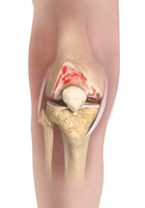 Knee Osteoarthritis Treatment - Educational Picture