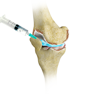 Nonsurgical Treatments for Arthritis - Educational Picture