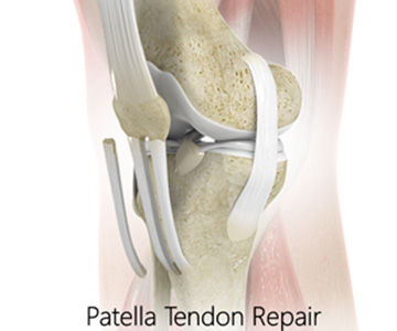 Patellar Tendon Repair - Educational Picture