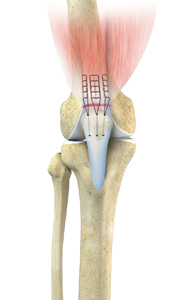 Quadriceps Tendon Repair - Educational Picture