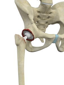 Revision Hip Replacement - Educational Picture