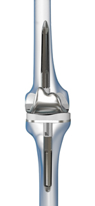 Revision Knee Replacement - Educational Picture