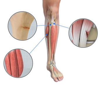 Shin splints - Educational Picture