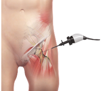 Snapping Hip Syndrome - Educational Picture