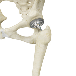 Total Hip Replacement - Educational Picture