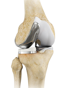 Unicompartmental/Partial Knee Replacement - Educational Picture