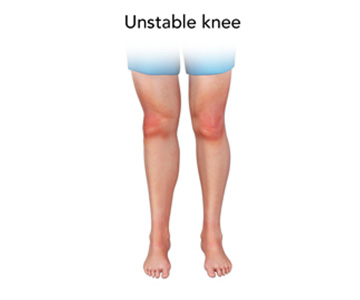 Unstable Knee - Educational Picture