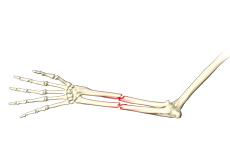Adult Forearm Fractures Images