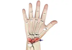 Arthritis of the Hand Images