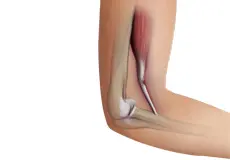 Biceps Tendon Tear at the Elbow Images