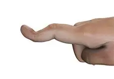 Boutonnière Deformity Images