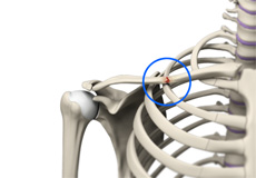 Clavicle Fracture Images