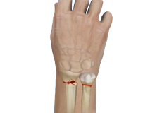 Complex Wrist & Hand Fractures Images