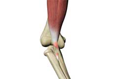 Distal Biceps Avulsion Images