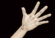 Distal Radius Fracture Images
