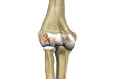 Elbow Arthritis Images