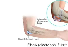 Elbow (Olecranon) Bursitis Images