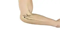 Elbow Dislocation Images