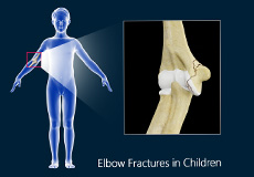 >Elbow Fractures in Children Images