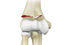  Elbow Fractures Images