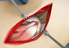 Elbow Surgery Images