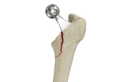 Femur Fracture Images