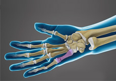 Finger Fractures Images