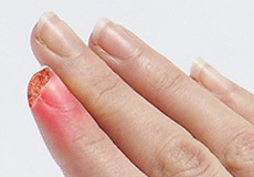 Fingertip Injuries/Amputations Images