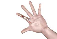 Flexor Tendon Injuries Images