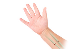 Forearm Fractures in Children Images