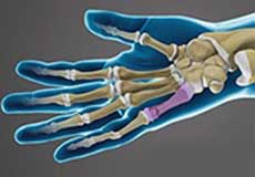 Hand Fractures Images