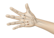 Hand Fractures Images