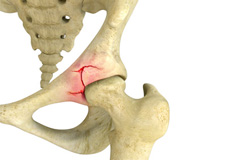  Hip Fracture Images