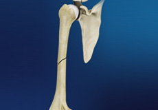 Mid Humeral Fracture Images