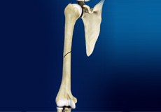Mid-Shaft Humerus Fracture Images