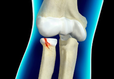 Radial Head Fractures Images