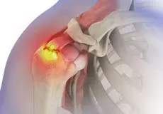 Rotator Cuff Tear Images