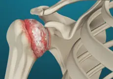 Arthritis of the Shoulder Images