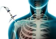 Shoulder Arthroscopy Images