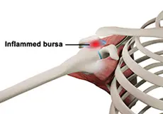 Shoulder Bursitis Images