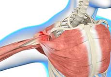Shoulder Impingement Images