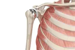 Shoulder Joint Replacement Images