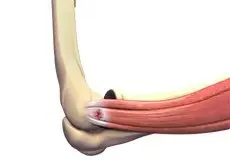 Tennis Elbow Images