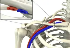Thoracic Outlet Syndrome Images